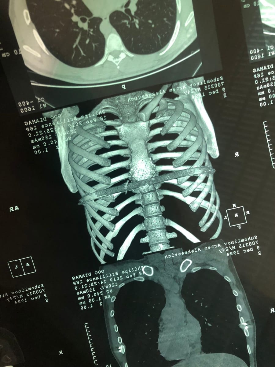 Каково это жить с врожденной воронкообразной деформацией грудной клетки, и  как её исправить